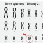 DOWN SYNDROME CAUSES AND RISK