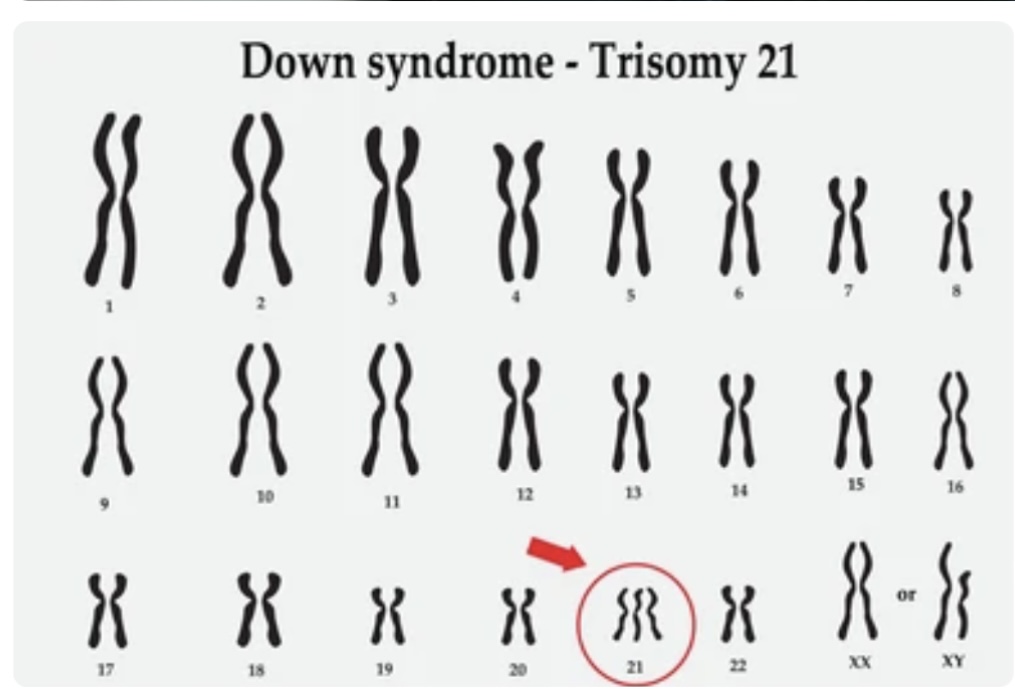 DOWN SYNDROME CAUSES AND RISK