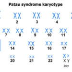 PATAU’S SYNDROME