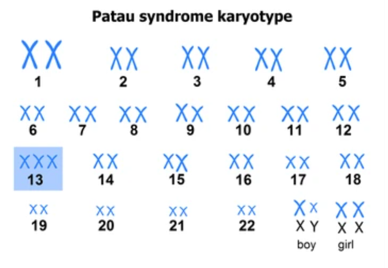 Read more about the article PATAU’S SYNDROME