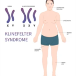 KLINEFELTER SYNDROME