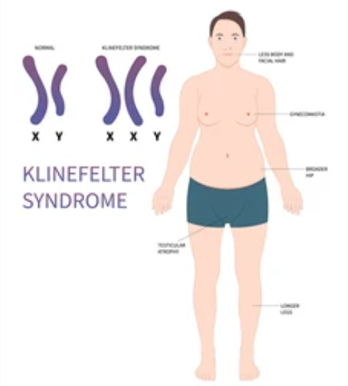 Read more about the article KLINEFELTER SYNDROME