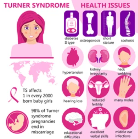 TURNER SYNDROME