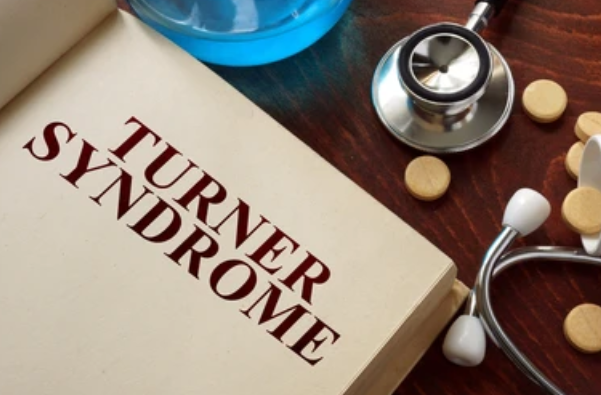 Read more about the article TURNER SYNDROME