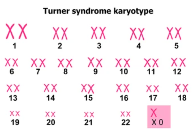 TURNER SYNDROME