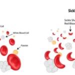 SICKLE CELL ANEMIA