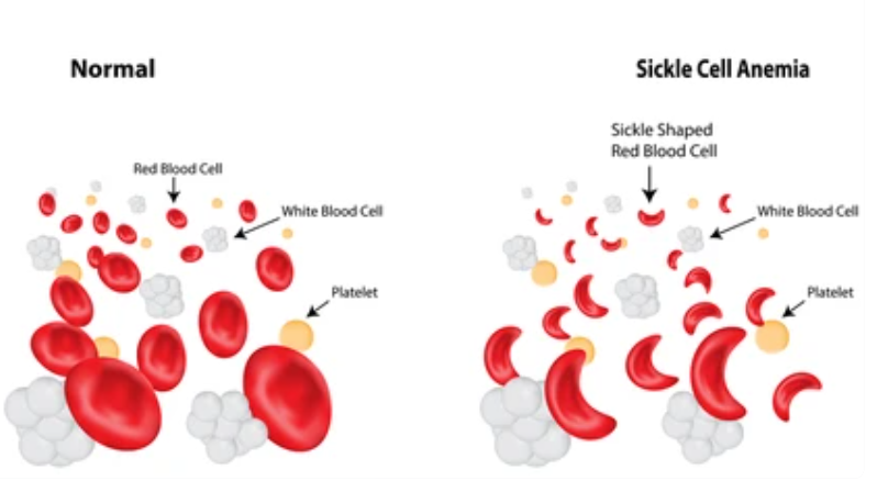 Read more about the article SICKLE CELL ANEMIA