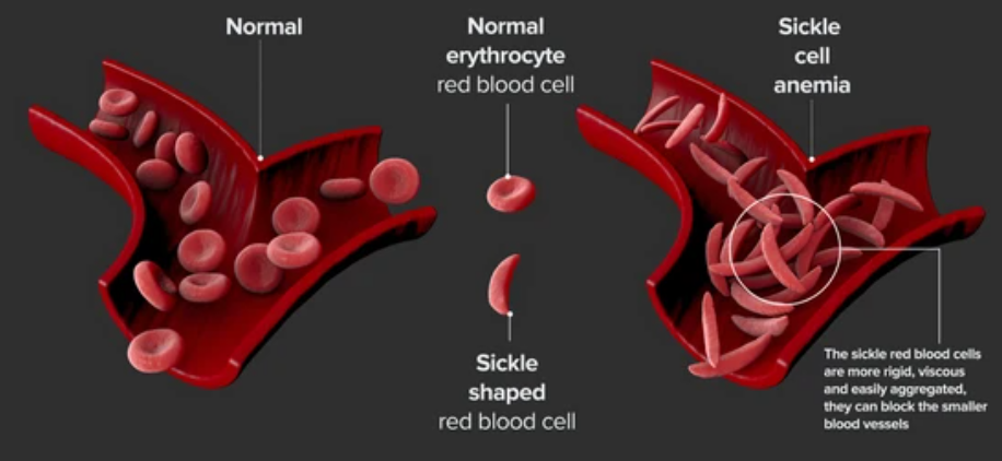 SICKLE CELL ANEMIA