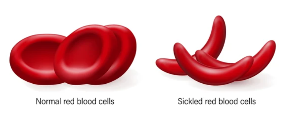 SICKLE CELL ANEMIA