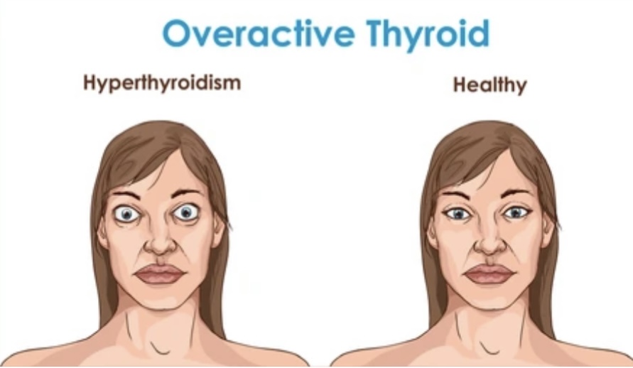 Hyperthyroidism