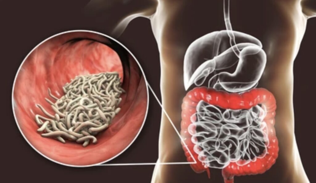 DISEASES CAUSED BY HELMINTHS