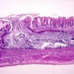 AMOEBIASIS - DISEASE CAUSED BY ENTAMOEBA HISTOLYTICA