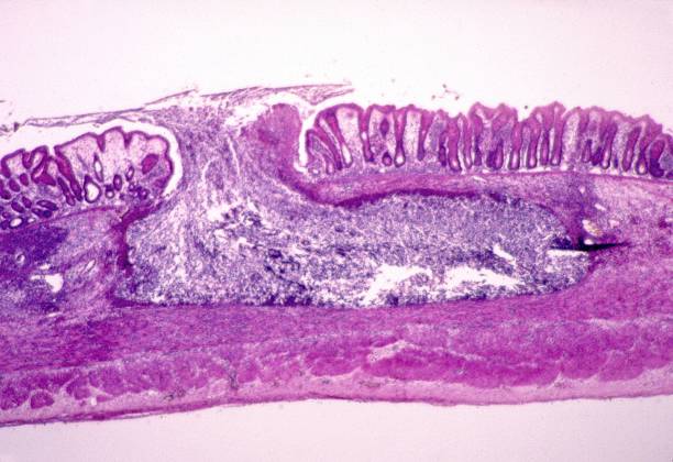 Read more about the article AMOEBIASIS – DISEASE CAUSED BY ENTAMOEBA HISTOLYTICA