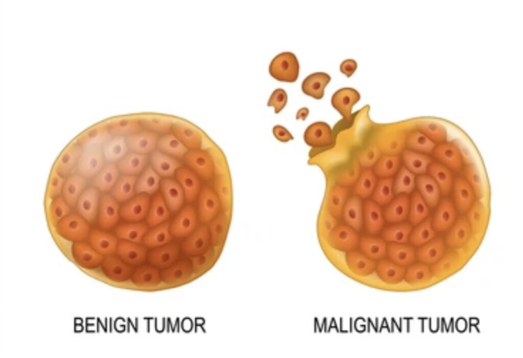 UNDERSTANDING TUMOURS: CAUSES, TYPES AND DIAGNOSIS