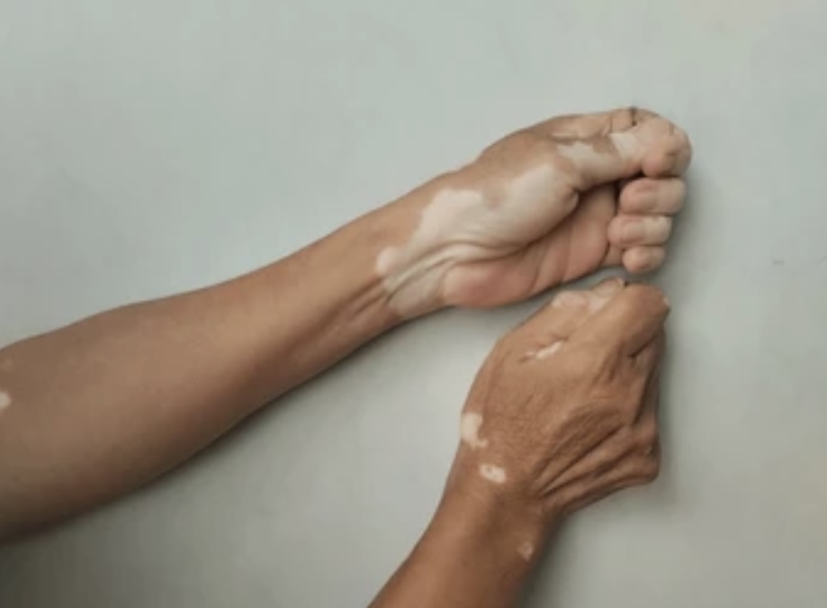 VITILIGO CAUSES