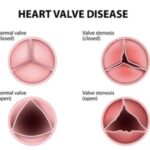 HEART VALVE DISORDERS