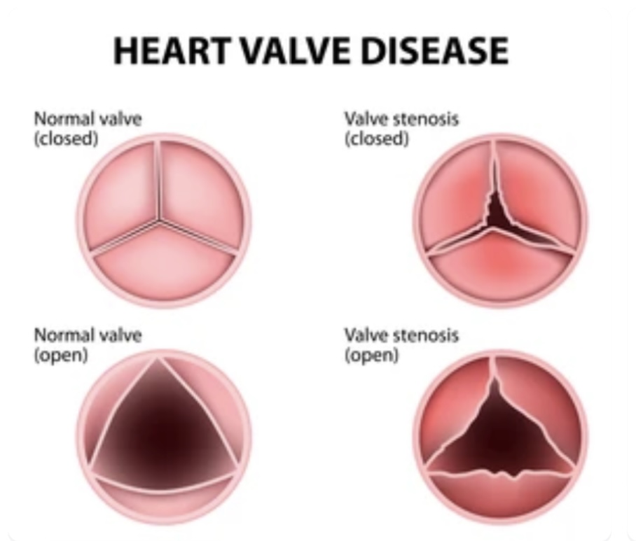 Read more about the article HEART VALVE DISORDERS