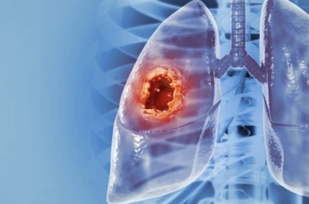 LUNG CANCER SYMPTOMS