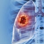 LUNG CANCER SYMPTOMS